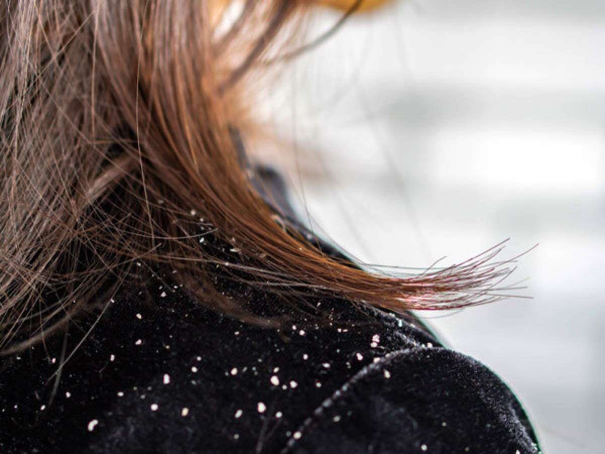 Five natural ways to get rid of dandruff this winter